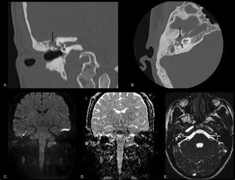 Attic Cholesteatoma Coronal And Axial Standard Reformats Ct Images