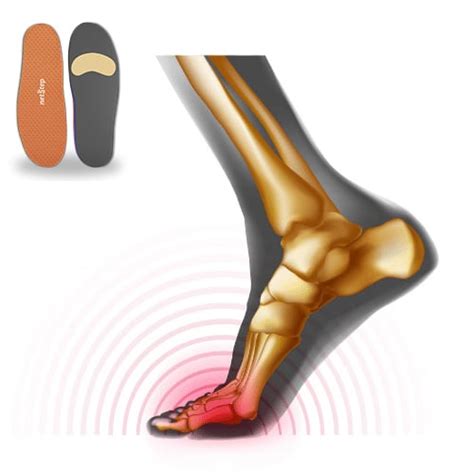 Custom Metatarsalgia Orthotics Netstep