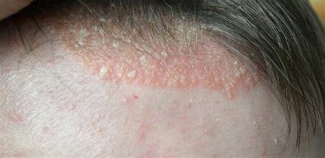 scalp psoriasis symptoms to watch out for all answers
