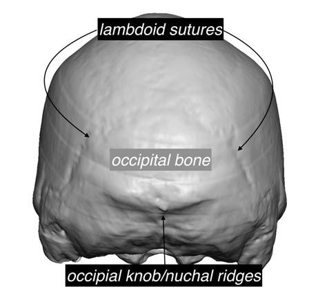 Plastic Surgery Case Study Occipital Skull Reduction With Parietal