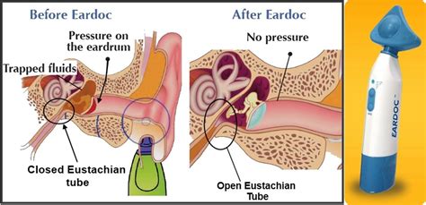 Eustachian Tube Dysfunction Etd And How To Treat It Ear Wax Removal