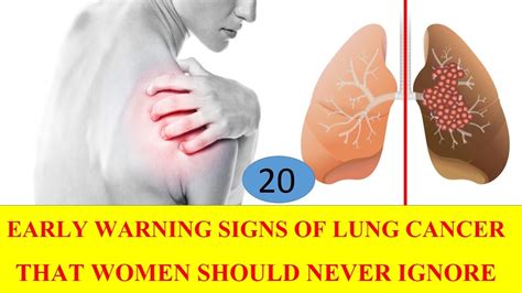 20 Early Warning Signs Of Lung Cancer That Women Should Never Ignore