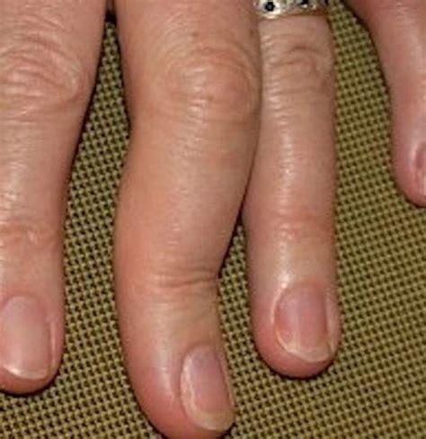 Psoriatic Arthritis In The Hands Symptoms Pictures And Treatment