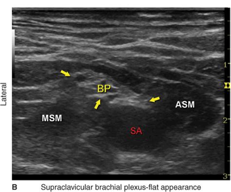 Ultrasound Guided Supraclavicular Brachial Plexus Block Hadzics