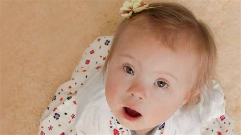 Früher, aber veraltet und diskriminierend: Mothers of children with Down Syndrome encouraged to ...