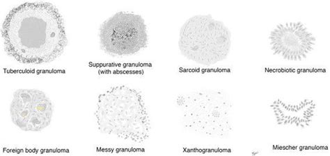 Types Of Granuloma Medizzy