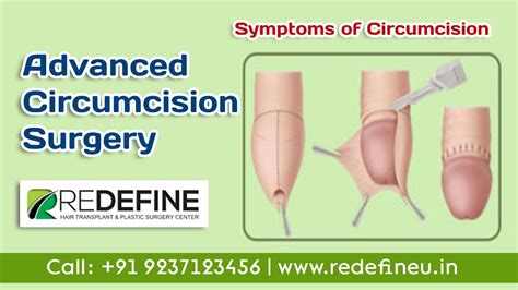 Best Hospital For Circumcision Surgery In Hyderabad Circumcision