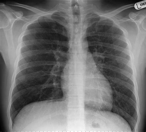 Lateral Chest Case Wikiradiography Hot Sex Picture