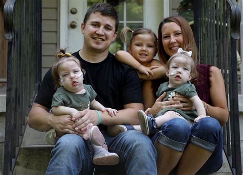 Conjoined Twins Successfully Separated In Michigan