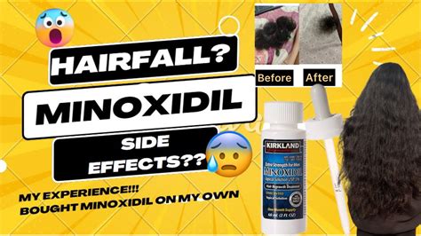 Minoxidil Causing Hairloss😱minoxidil Is Temporary😨using Minoxidil