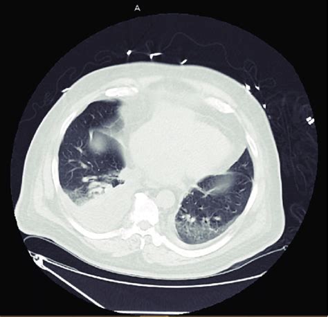Ct Scan Chest Right Sided Pleural Effusion Anterior Mediastinal Mass