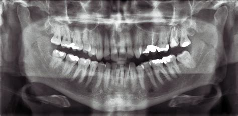Panoramic Dental X Ray Photograph By Photostock Israel