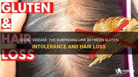 Celiac Disease The Surprising Link Between Gluten Intolerance And Hair