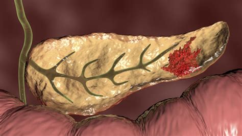 Most Deadly Form Of Pancreatic Cancer Reveals Potential Therapeutic Targets