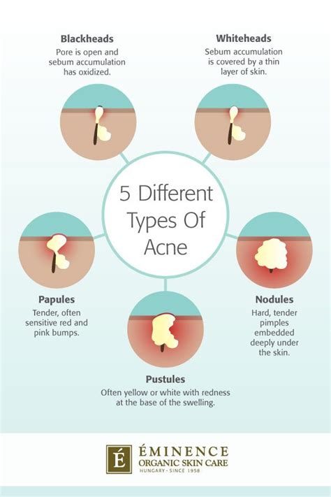 Types Of Acne The Differences Between Your Bumps And Blemishes