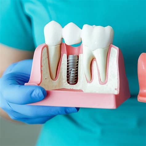 Front Teeth Implants Miami Fl Dentist Brickell Dental General