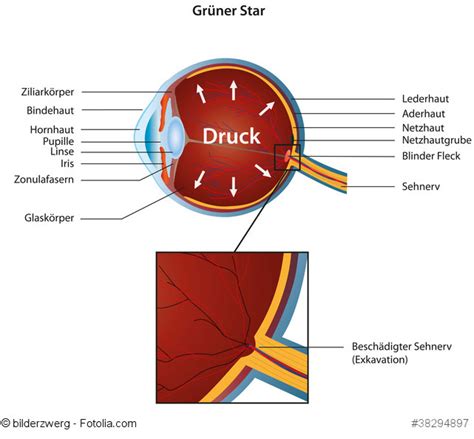 Glücklicherweise gibt es neben medikamentöser behandlung auch einige ganz natürliche maßnahmen, mit denen sie den augendruck reduzieren und die augengesundheit fördern können. Grüner Star (Glaukom) - ist ein erhöhter Augeninnendruck ...