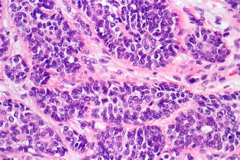 Pathology Outlines Adenoid Cystic Basal Cell Carcinoma