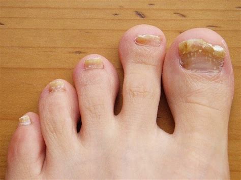 How To Get Rid Of Toe Nail Fungus Healthproadvice
