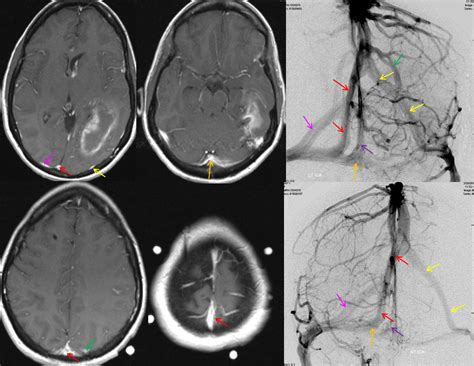 Superior Sagittal Sinus