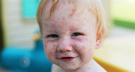 The Chicken Pox Vaccine Babycenter