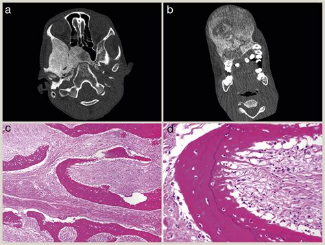 Histopathology Of Fibro Osseous And Cystic Tumors Of Bone Diagnostic