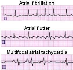 Atrial Flutter Vs Atrial Fibrillation Ecg