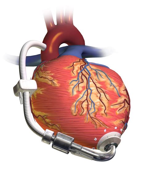 Left Ventricular Assist Devices Lvads