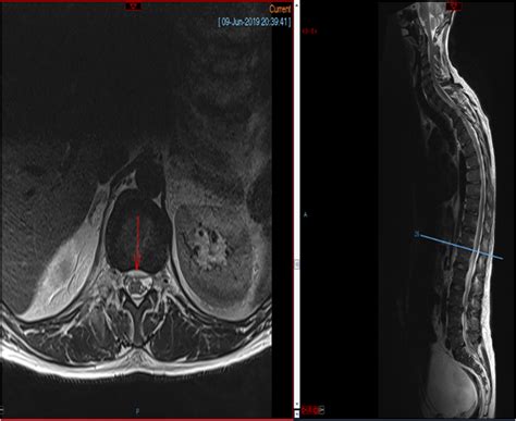 Figure 2 Axial And Sagittal Section Of Mri Showing Epidural Abscess
