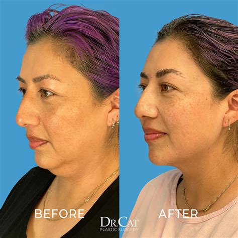 How To Achieve A Slim Face With Buccal Fat And Chin Lipo