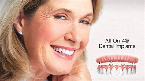 All On 4 Dental Implants Guide In Houston Texas Omega Dentists