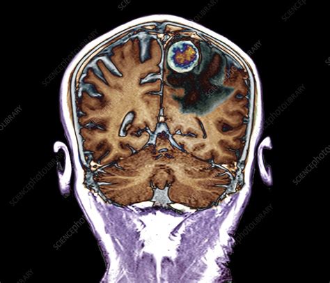 Secondary Brain Cancer Mri Scan Stock Image C0403197 Science
