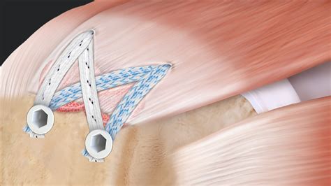 Arthrex Speedbridge™ Rotator Cuff Repair With Knotless Swivelock