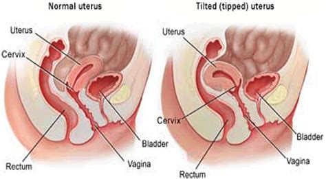 Tilted Uterus Causes Symptoms Diagnosis Treatment And Pregnancy