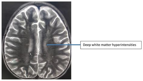 Mri Of The Brain Multiple Enhancing Confluent White Matter Lesions Of