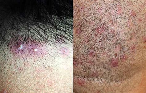 Head Sores Scalp Folliculitis