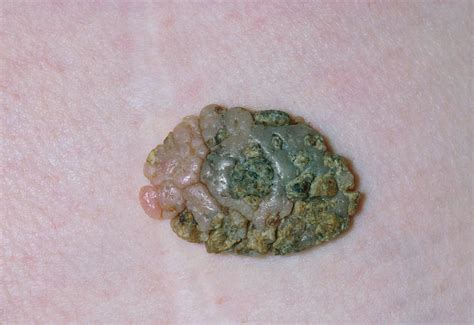 Seborrhoeic Wart Removal Photograph By Dr P Marazzi Science Photo