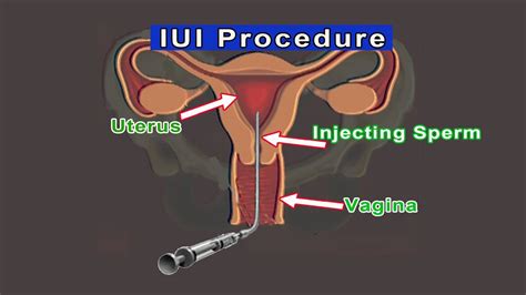 How To Iui Process The Procedure Can Be Used To Address A Variety Of
