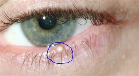 Pimples on your balls are totally normal. White Bump on Eyelid, Small, Under, Inside, on Lower Rim ...