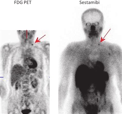 Visualization Of Solitary Cervical Lymph Node Metastasis By 18 F