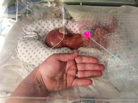 One Of Uks Most Premature Babies Defied Odds After Being Born At 22