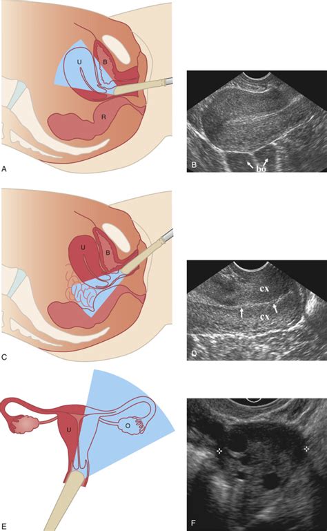 Normal Anatomy Of The Female Pelvis And Transvaginal Sonography Radiology Key