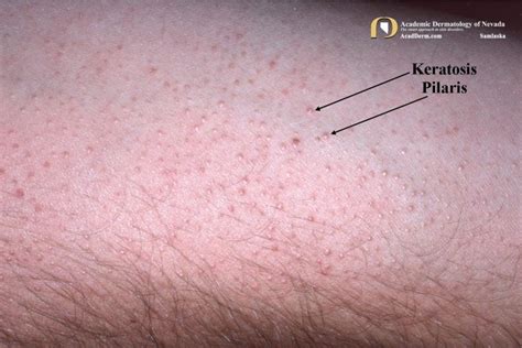 Keratosis Pilaris It Feels Like Sandpaper Academic Dermatology Of