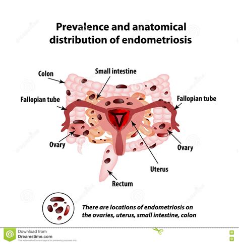 In addition to medical approaches, you may find some relief of symptoms and stress of endometrioma by adjusting certain aspects of your lifestyle, such as: Endometriosi L'aspetto Dell'endometriosi Di Malattia Endometrio Colon Piccolo Intestino ...