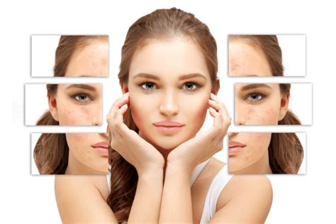 Fotona Twinlight™ Laser Acne And Acne Scars Treatment Toronto Pure
