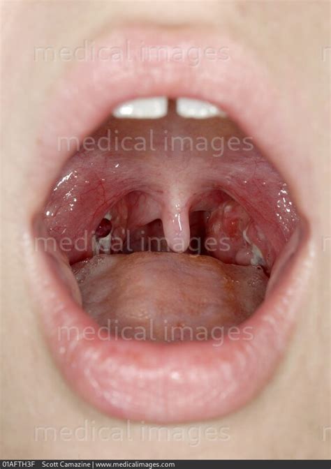 Stock Image Close Up Of The Throat Showing An Infection With Exudative