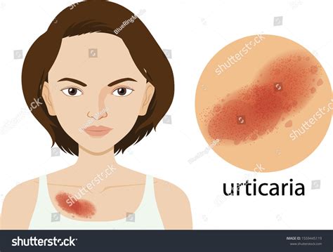 Diagram Showing Urticaria On Human Female Stock Vector Royalty Free