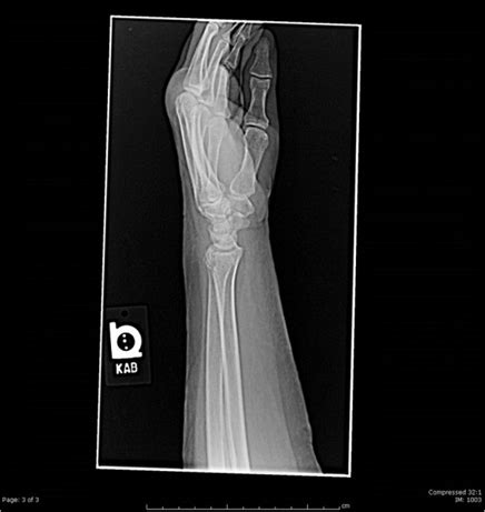 Wrist Pain After A Fall: More Than A Simple Fracture