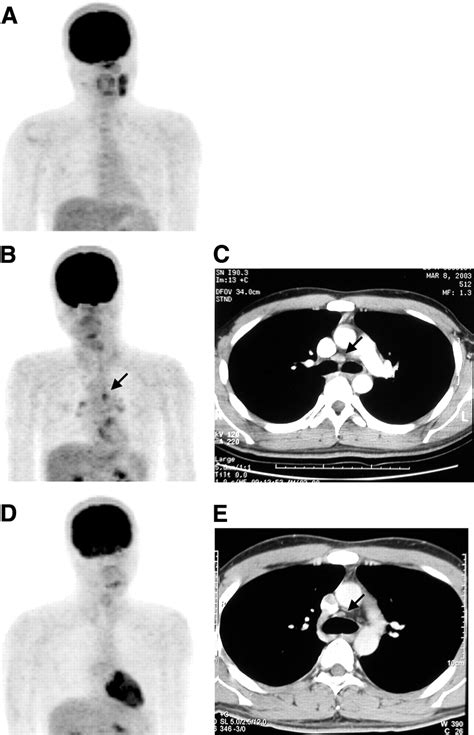 The Value Of 18f Fdg Pet In The Detection Of Stage M0 Carcinoma Of The