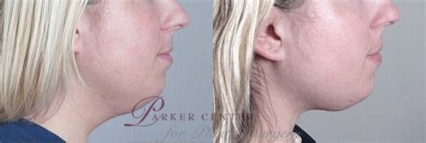 Neck Contouring Before And After Photo Gallery Paramus Nj Parker